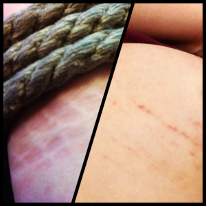 Compression marks and rope petechiae.